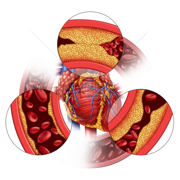 心脏动脉疾病和冠状体医学概念是逐渐形成的板块造堵塞的动脉和无神体硬化与带有3D插图元素的胆固醇人体解剖一样图片