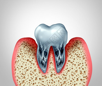 3D说明由于细菌感染以及骨骼腐烂和口香糖炎的洞穴或牙齿口腔疾病和垂口腔卫生问题很差图片