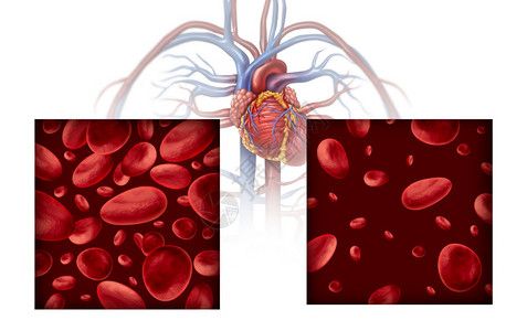 贫血和病医学图表概念是正常和异的血细胞计数动脉或血管中的人体循环是白色背景的3D插图背景图片