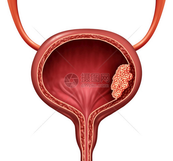 人体膀胱癌是一种尿道解剖器官疾病恶细胞概念是3D插图切除身体解剖图片