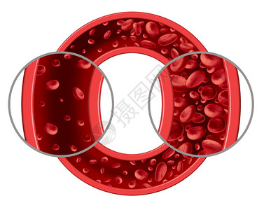 贫血和病医学图表概念是正常和异的血细胞计数动脉或血管中的人体循环是3D插图孤立在白色背景上背景图片