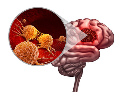脑癌解剖概念和恶肿瘤或象征作为神经学身体的一部分恶细胞以3D插图元素分裂和扩散的微放大作用图片