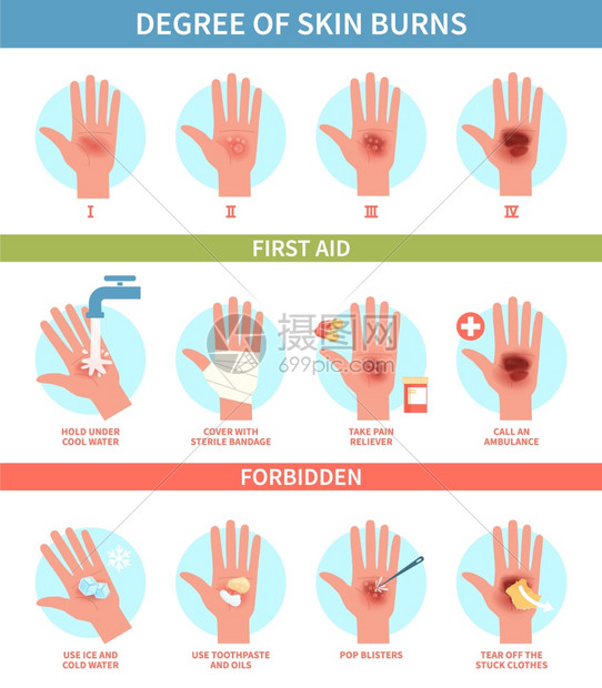烧伤程度热急救红皮肤烧伤和泡紧急救助治疗指导热伤医南信息海报帮助诊所扁矢量测步骤热伤急救皮肤烧和泡紧急救助信息海报帮扁矢量测步骤图片