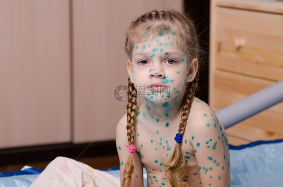 患有天花的小女孩被绿点覆盖图片