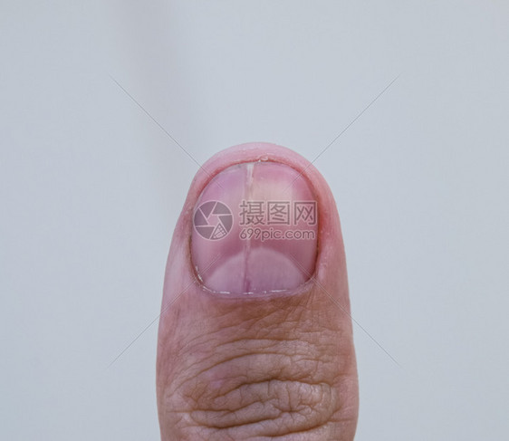 指甲钉在拇上甲创伤病理学指甲被一分为二指甲在拇上图片