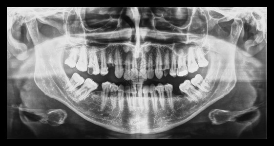 医疗X光人体牙齿的医学X光成像图片
