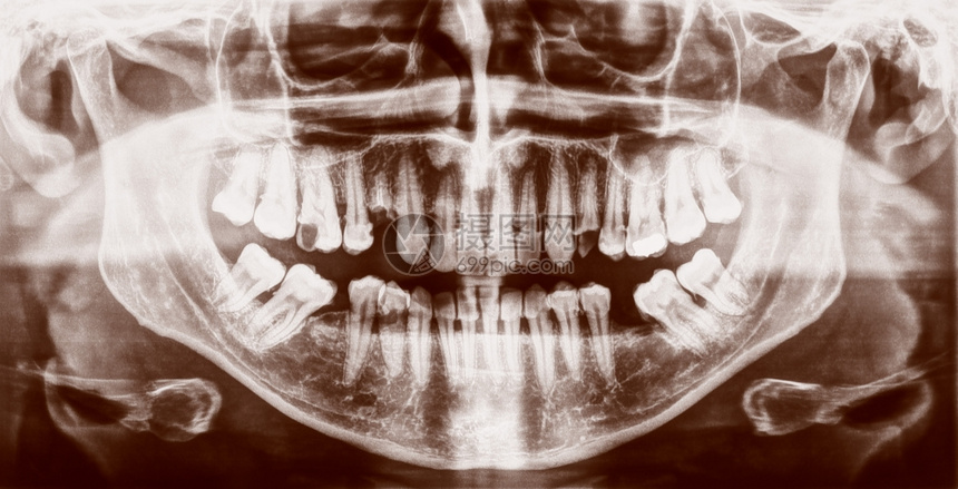 ‘~医疗X光片人体牙齿的医学X光成像  ~’ 的图片