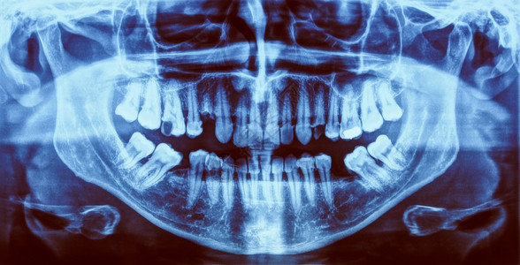 医疗X光片人体牙齿的医学X光成像图片