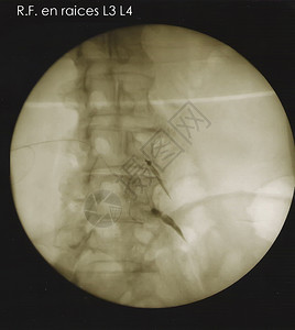 根底脊椎射电图图片