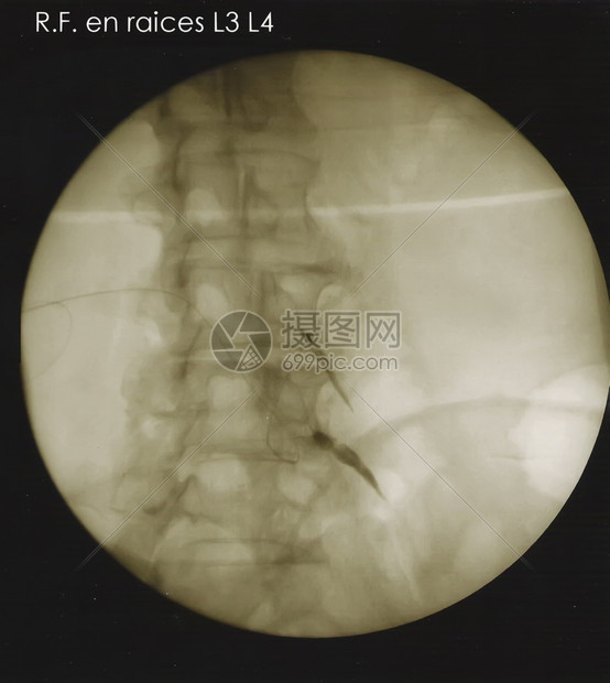 根底脊椎射电图图片