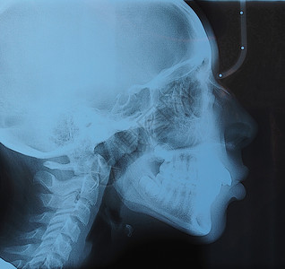 医疗x光儿童头骨牙齿和脊椎的医学x光成像图片素材