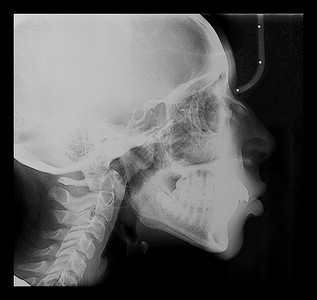 医疗x光儿童头骨牙齿和脊椎的医学x光成像图片素材