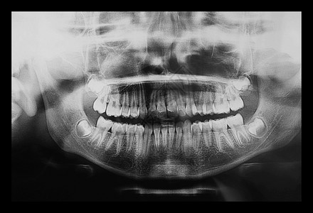 医疗x光儿童牙齿的x光成像图片素材