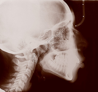 儿童头骨牙齿和脊椎的医学x光成像图片素材