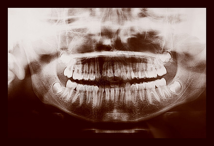 医疗X光片儿童牙齿的医学X光成像图片