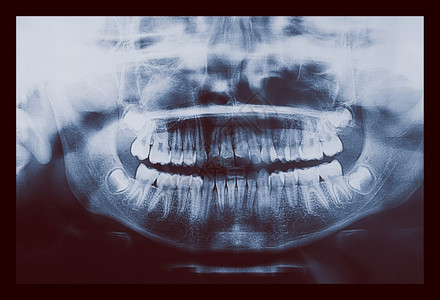 医疗X光片儿童牙齿的医学X光成像图片