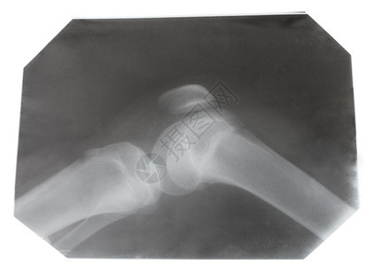白背景隔离的人类膝关节X光照片图片
