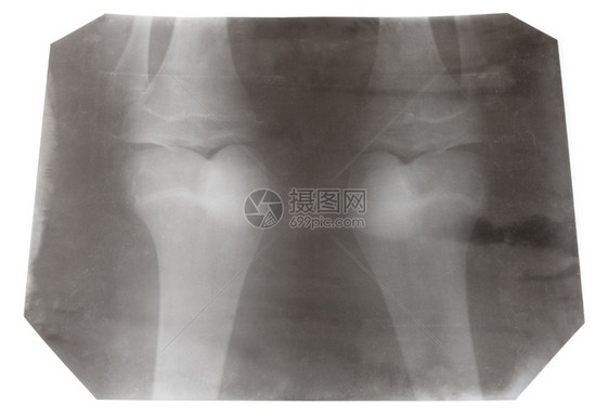 X光照片两条人膝关节与白背景隔离的两条人膝关节图片