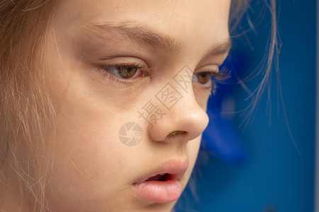 孩子双眼结膜炎图片