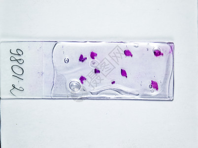 玻璃下肿瘤的切片对细胞进行生理学检查以发现癌症在灯底部的渗漏下肿瘤细胞样本对肿瘤细胞进行生理学检查以发现癌症图片
