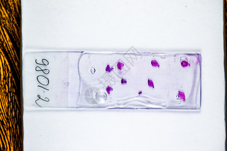 玻璃下肿瘤的切片对细胞进行生理学检查以发现癌症在灯底部的渗漏下肿瘤细胞样本对肿瘤细胞进行生理学检查以发现癌症图片