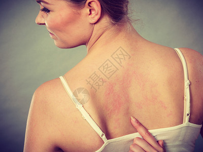 年轻女皮肤病和过敏疹症状显示她有痒的背部图片