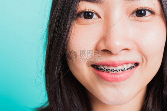 紧关近身的亚裔年轻美女微笑牙齿套在上笑摄影棚拍在蓝背景上被孤立药物和牙科女口腔概念图片