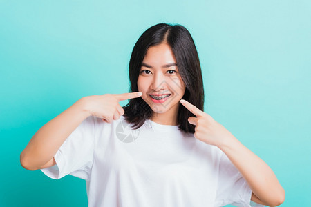 亚洲年轻美丽的女子微笑肖像有牙套齿笑尖指她的嘴摄影棚拍以蓝背景孤立医学和牙概念图片