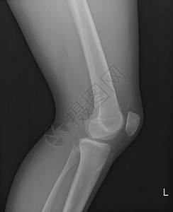 X射线人体膝盖电图显示由于年轻女病人的失常们膝盖有投票和普遍超高血压膝盖射线X光图片