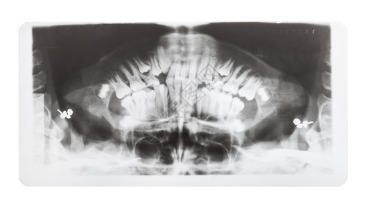 白色背景隔离的人类下巴X光图像片图片