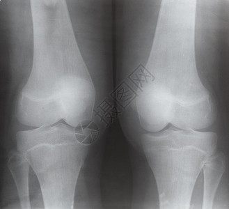 X光图像上两个人的膝关节前视线图片