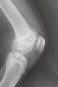 在X光图像上膝盖骨与相连接的人类膝盖侧面图片