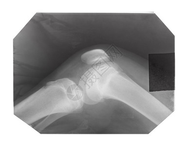 与白色背景孤立的膝盖骨相连接X光胶片图片
