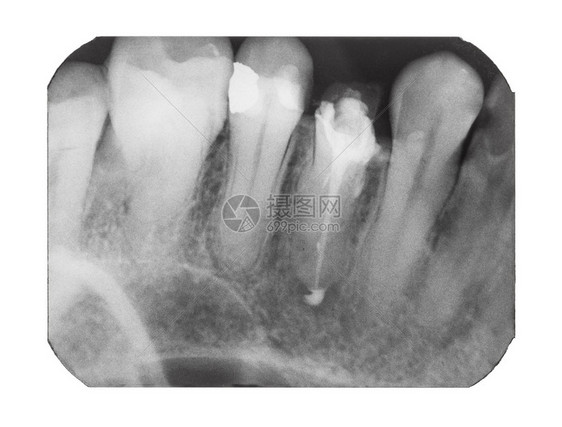 以白色背景隔离的牙针拍摄人类齿X光照片图片
