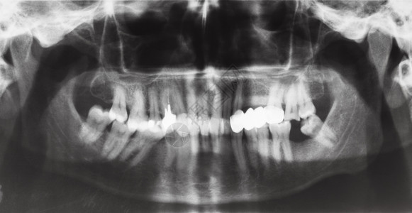 以牙冠和X光图象上的牙齿针刺图片