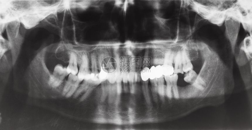 以牙冠和X光图象上的牙齿针刺图片