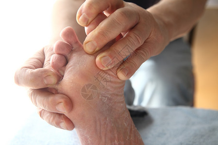 脚和趾之间皮肤干燥的人健康手指糖尿病图片