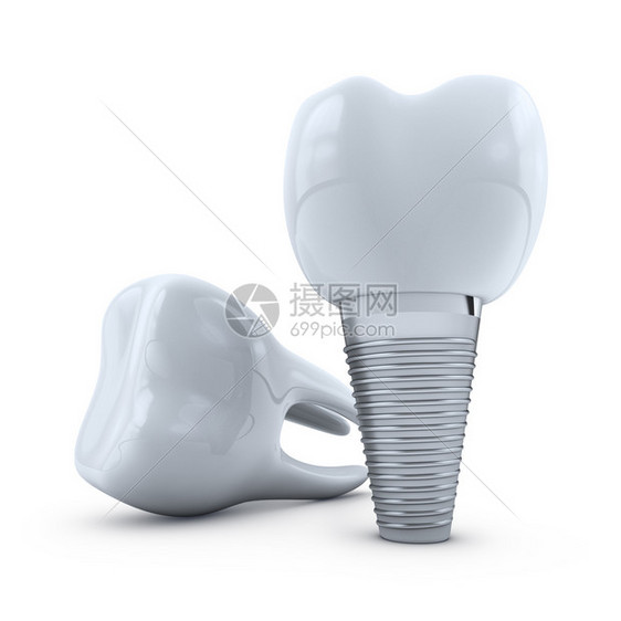 凹痕医疗的白色背景上牙齿植入物和臼3d渲染口腔科图片