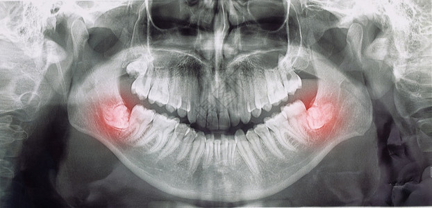 各种不同的智慧牙齿问题概念牙齿X光图像扫描全景象等不同类型的智慧牙齿问题医疗的有角度堵塞图片