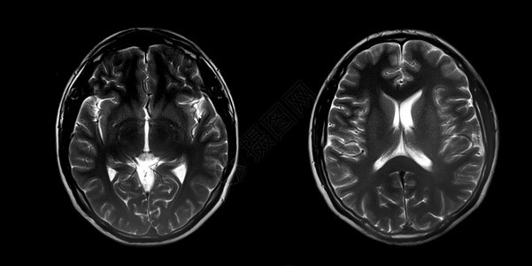 黑色的谐振正常大脑磁共振图像MRI全光脑断层摄影健康图片