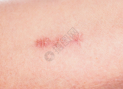 药物皮肤缝合伤口周围的红色紧闭手臂医院图片