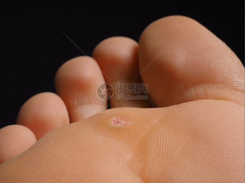女士皮肤脚跟紧一个被感染的蚊子放在脚趾下与黑色隔绝男人图片