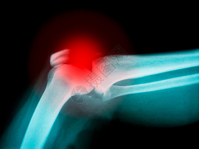 弯头电影经过人体手臂X光片显示骨折和红亮点图片