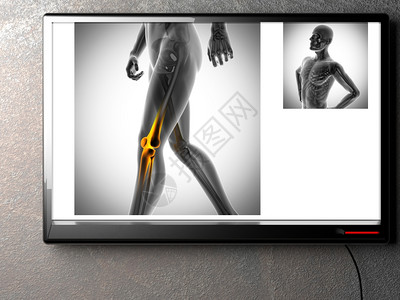 医疗的X射线扫描X光图像联合的膝盖图片