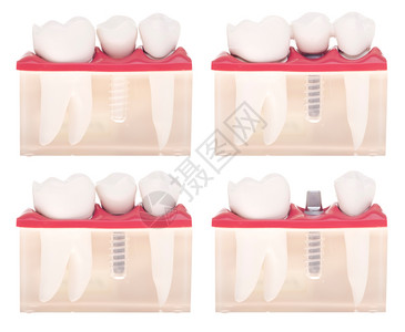 关心学习嘴具有不同类型治疗的牙科模植入安插紧固桥架白种背景孤立的植入加皇冠背景