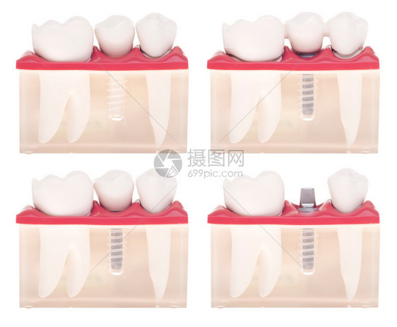 关心学习嘴具有不同类型治疗的牙科模植入安插紧固桥架白种背景孤立的植入加皇冠图片