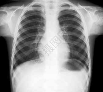 身体医疗的X光照人胸部X片医生图片