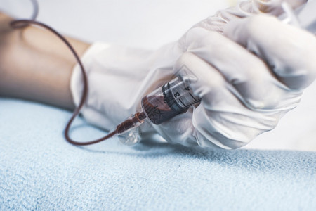 高血压治疗一种使用医注射器对病人用医疗注射器抽血并用医疗注射器进行输血图片