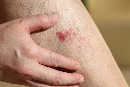 警告损害痛男人腿上的伤口图片