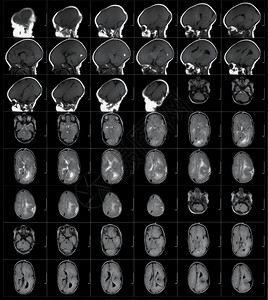 解剖学病人医疗的MRI人体头部扫描图片